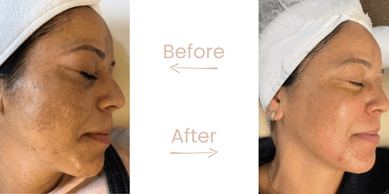 before-after-gg-8